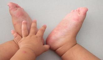 FAQs About Hand, Foot and Mouth Disease