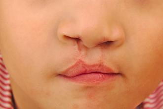 Cleft Lips and Cleft Palate