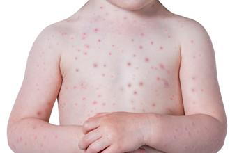 Know the Signs of Chickenpox
